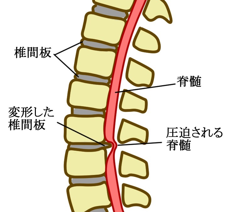 脊椎疾患　椎間板ヘルニア