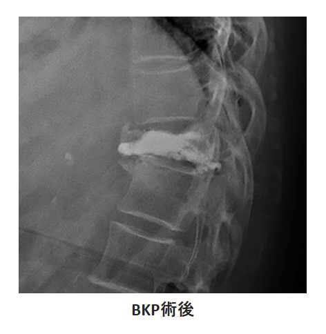 脊椎疾患　腰椎圧迫骨折BKP