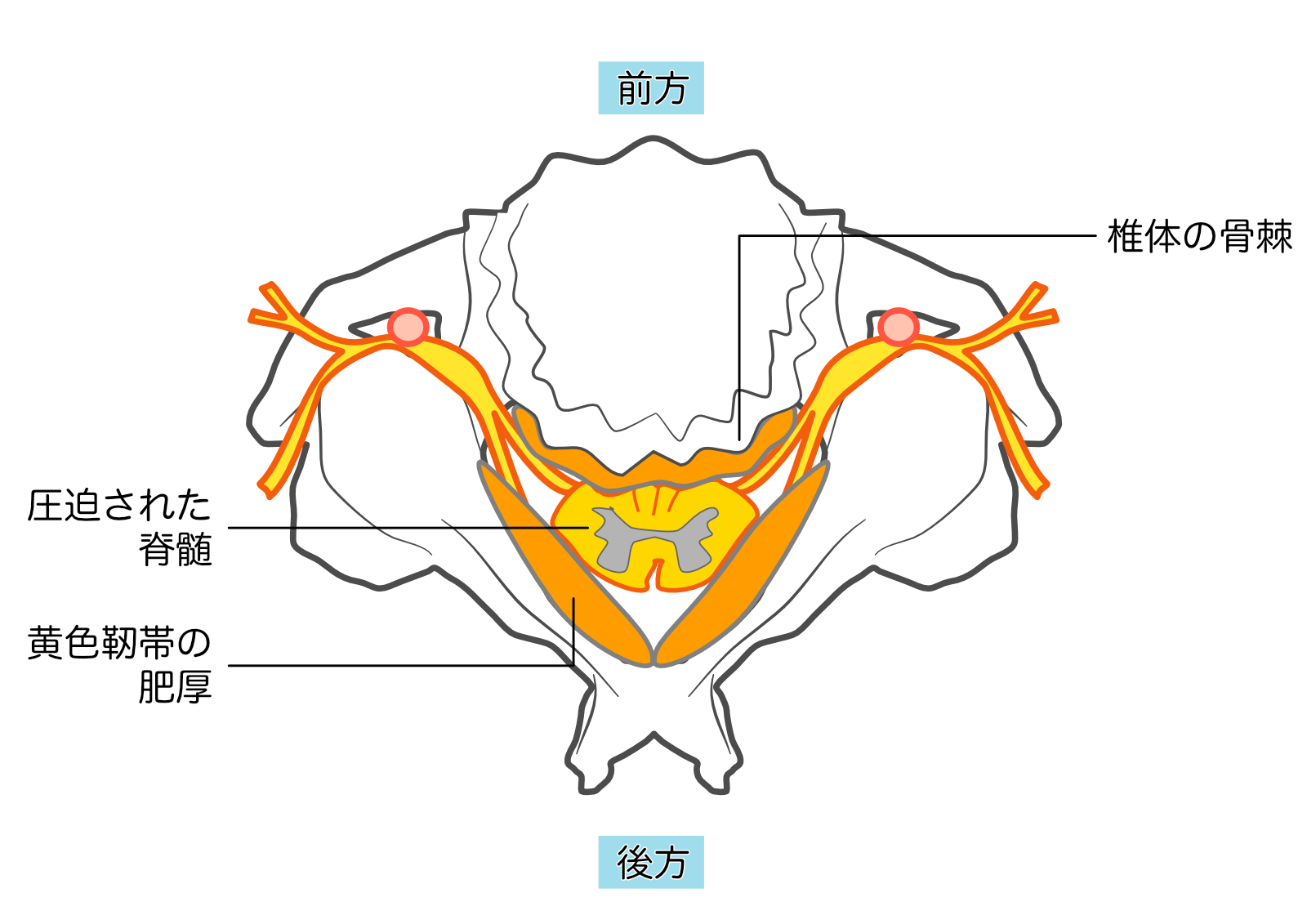 脊椎疾患　頚椎症性脊髄症