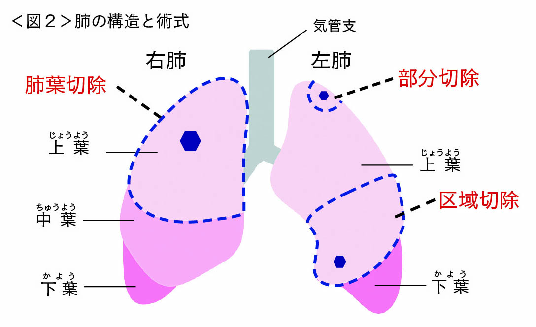 肺の構造と術式