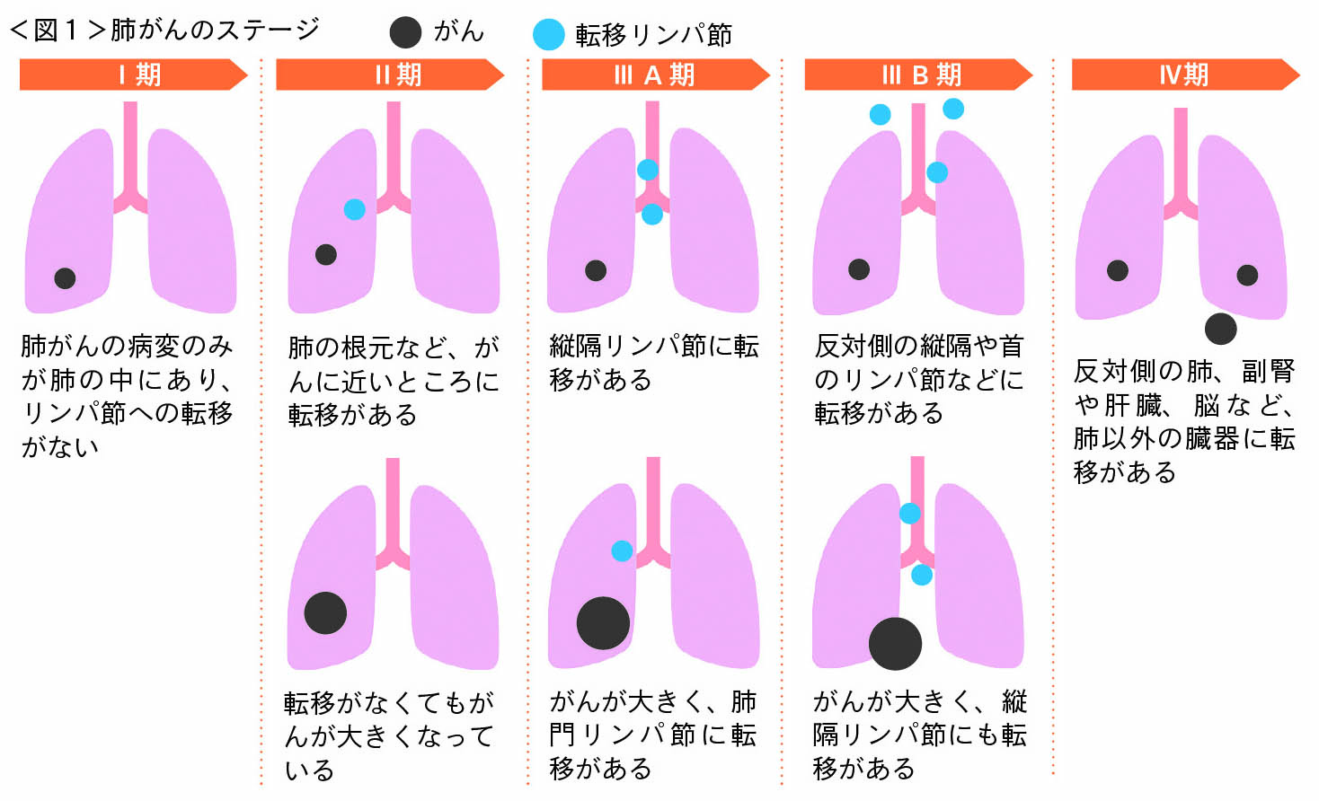 肺がんのステージ