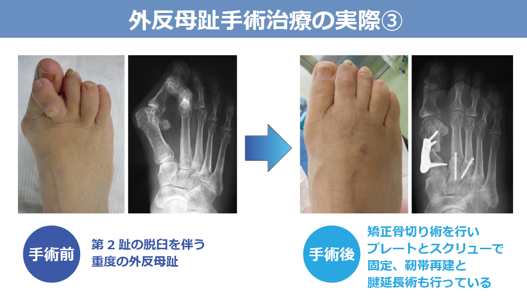 外反母趾手術治療の実際③