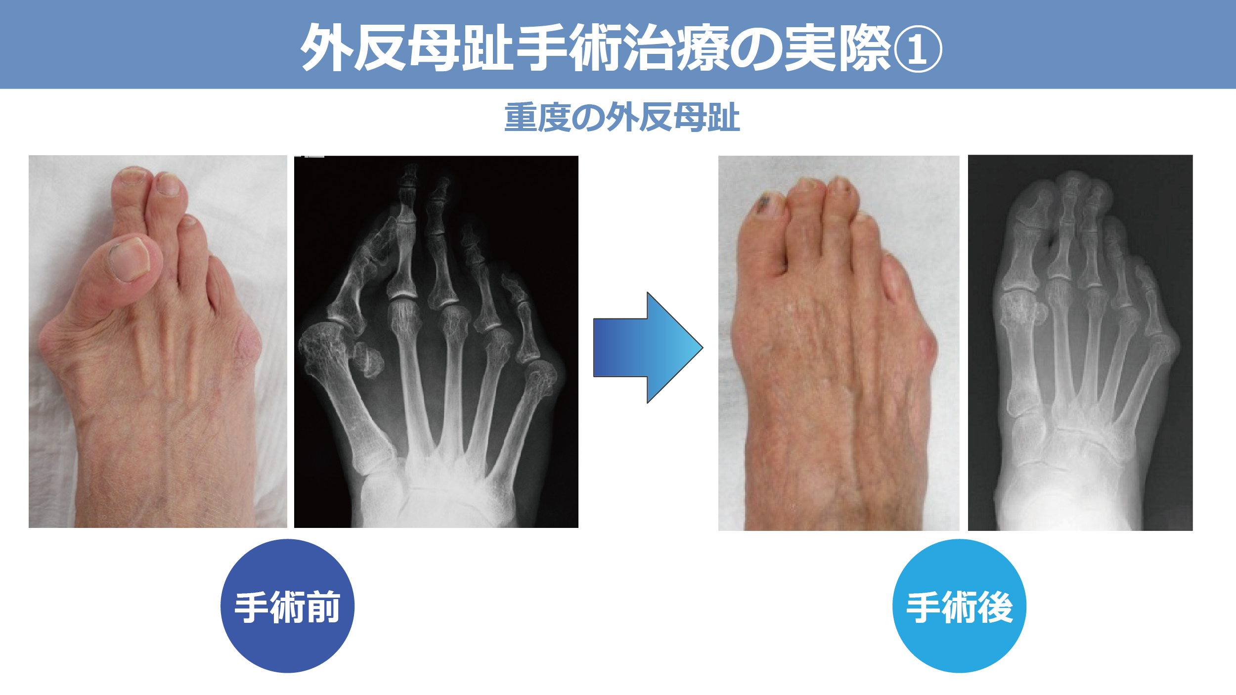 外反母趾手術治療の実際①