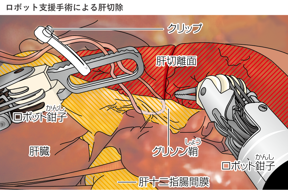 ロボット肝切除イメージ